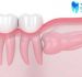 Nhổ răng khôn mọc lệch 90 độ có khó không? – Nhổ răng khôn Nha Trang