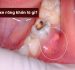 Áp xe răng khôn là gì? Có nguy hiểm không?