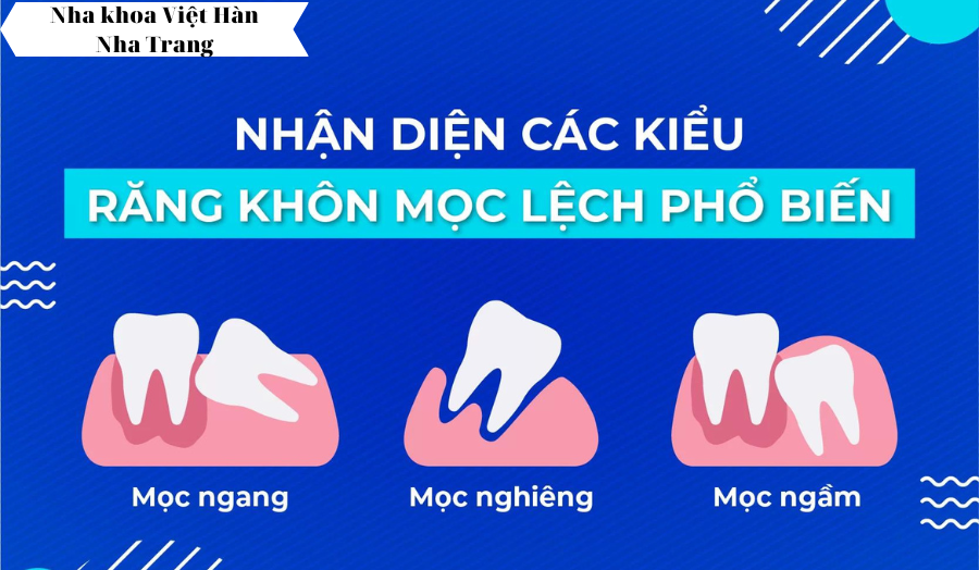 co-nhat-thiet-phai-nho-rang-khon-khong
