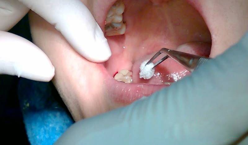Cảnh báo khi nhổ răng khôn bị nhiễm trùng
