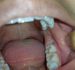 Nhổ răng hàm tại nhà có thể xảy ra biến chứng gì?